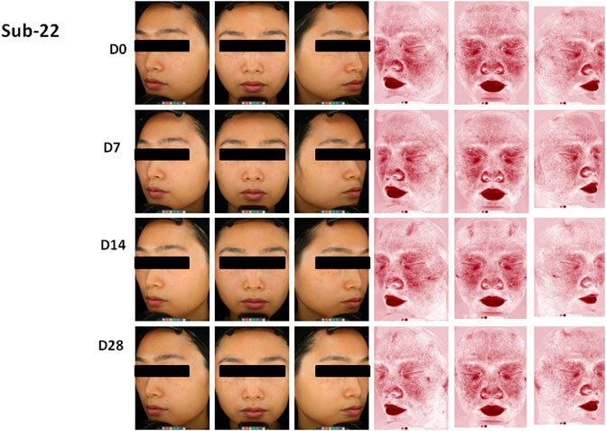 Images showing reduction of skin redness in volunteer over 28 days compared to baseline.